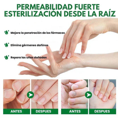 Compra 1 y llevate 2👋🦠Anti Hongos Uñas - 7 Days™  2UND 30ml
