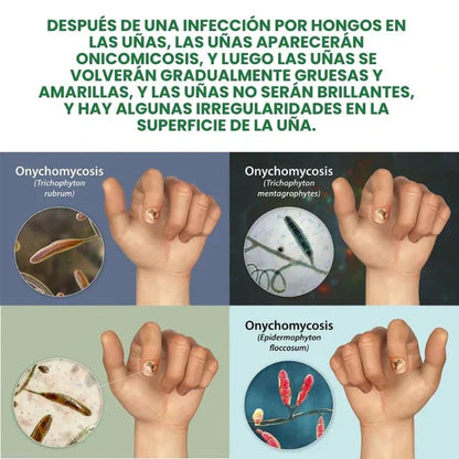 Compra 1 y llevate 2👋🦠Anti Hongos Uñas - 7 Days™  2UND 30ml