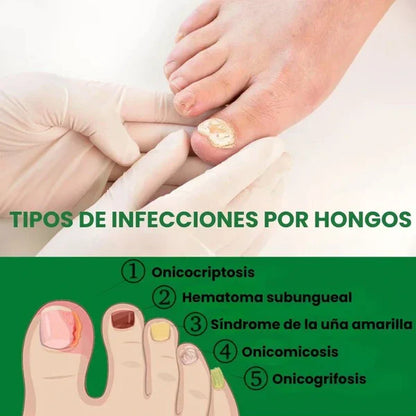 Compra 1 y llevate 2👋🦠Anti Hongos Uñas - 7 Days™  2UND 30ml