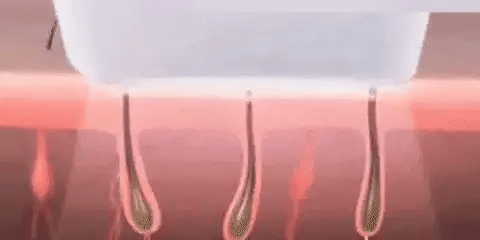 Depiladora Láser Sin Dolor