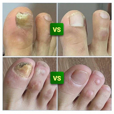 Compra 1 y llevate 2👋🦠Anti Hongos Uñas - 7 Days™  2UND 30ml